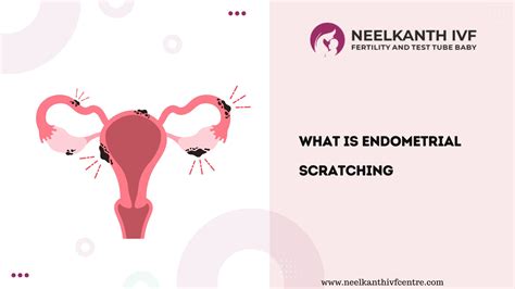 endometrial scratching before implantation